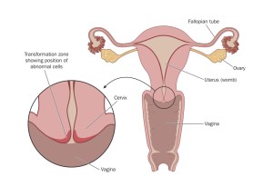 An Muttermund und Gebärmutterhals (im Bild „Cervix“, links vergrößert) findet sich die Übergangszone. Hier können HP-Viren eindringen und sich festsetzen.