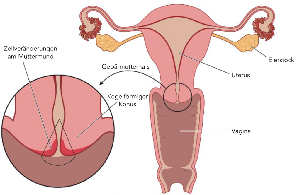 hpv vírus gebarmutter entfernen)