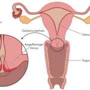 Bei Gebärmutterhalskrebs wird oft eine Konisation durchgeführt - Gebärmutterkrebs ist in der Gebärmutter selbst lokalisiert.