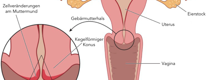 Bei Gebärmutterhalskrebs wird oft eine Konisation durchgeführt - Gebärmutterkrebs ist in der Gebärmutter selbst lokalisiert.