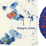 links: Pap-Test mit eingefärbten Zellen und Tumorzellen, rechts: HP-Virus