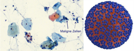 links: Pap-Test mit eingefärbten Zellen und Tumorzellen, rechts: HP-Virus