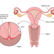 Cervical Cancer