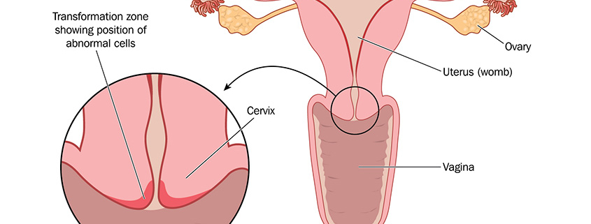 Cervical Cancer And Uterine Body Cancer What Is The Difference